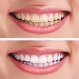 Блестящо бели зъби за ослепителна усмивка.