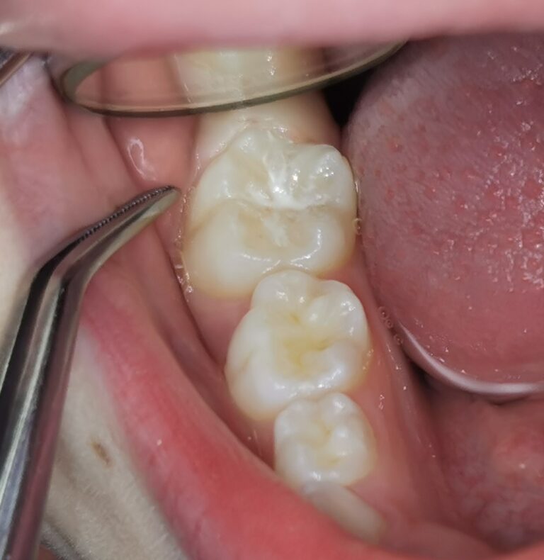 Поставяне на силанти на детски кътни зъби