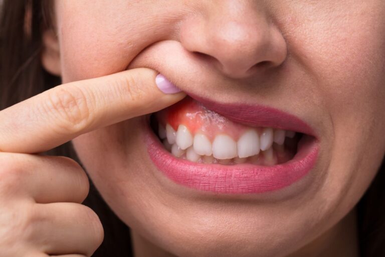 Професионалното почистване на зъбите предотвратява заболявания на венците.