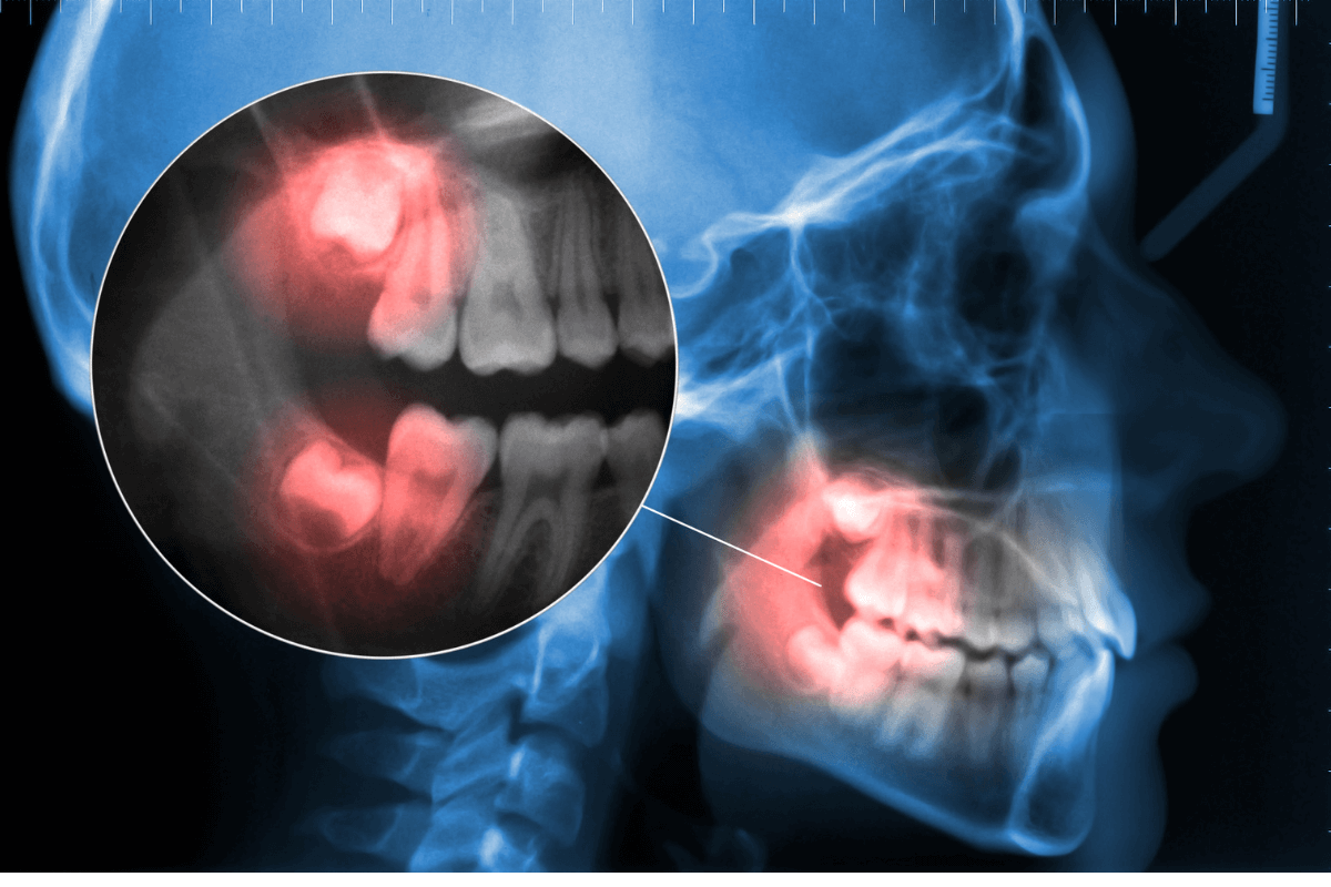 Вадене на мъдрец - всичко, което трябва да знаем