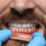 Възпление на венците - симптоми, лечение и превенция