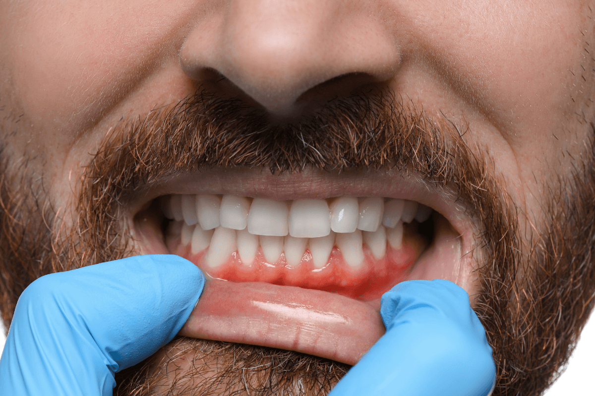 Възпление на венците - симптоми, лечение и превенция