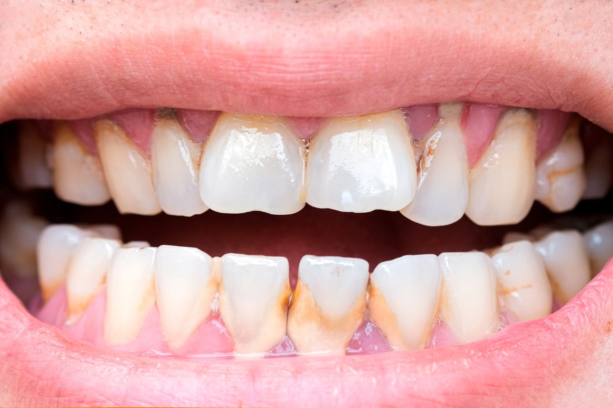 Зъбен камък - популярни митове