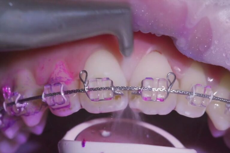 Кабинетното почистване на зъбите не вреди на емайла