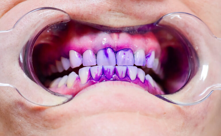 Професионално почистване на зъбите от зъбен камък