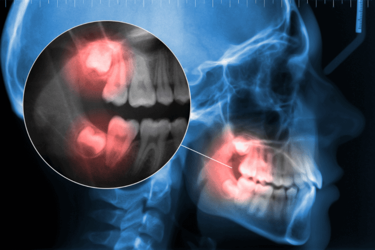 Видове ретиниран мъдрец