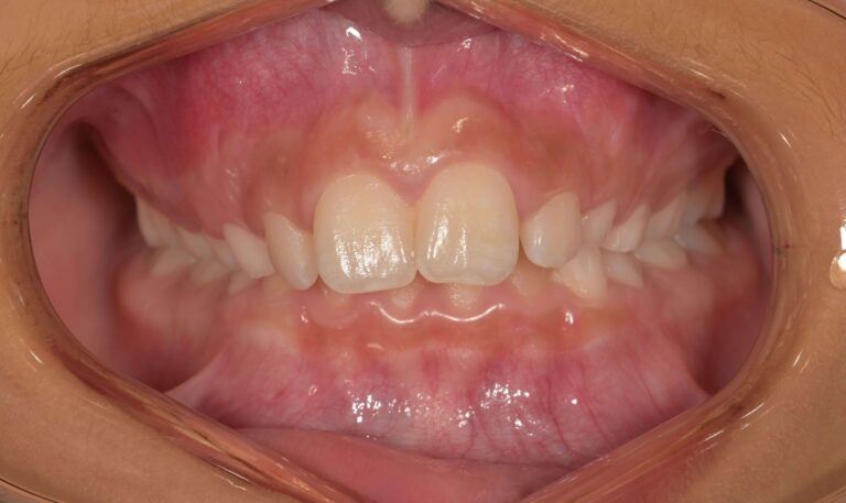 Изпъкнали предни зъби