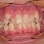 Видове захапка - ортодонтско лечение