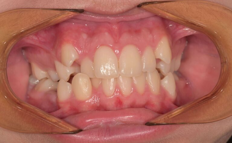 Видове захапка - ортодонтско лечение