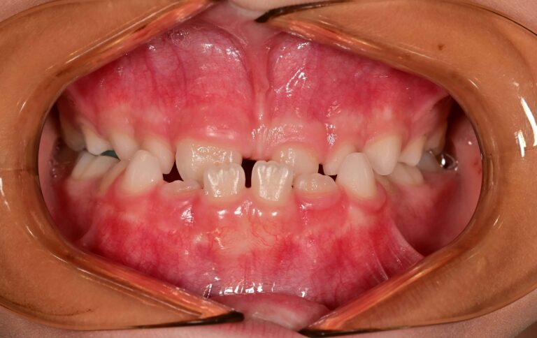 Обратна захапка