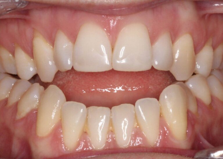 Отворена захапка