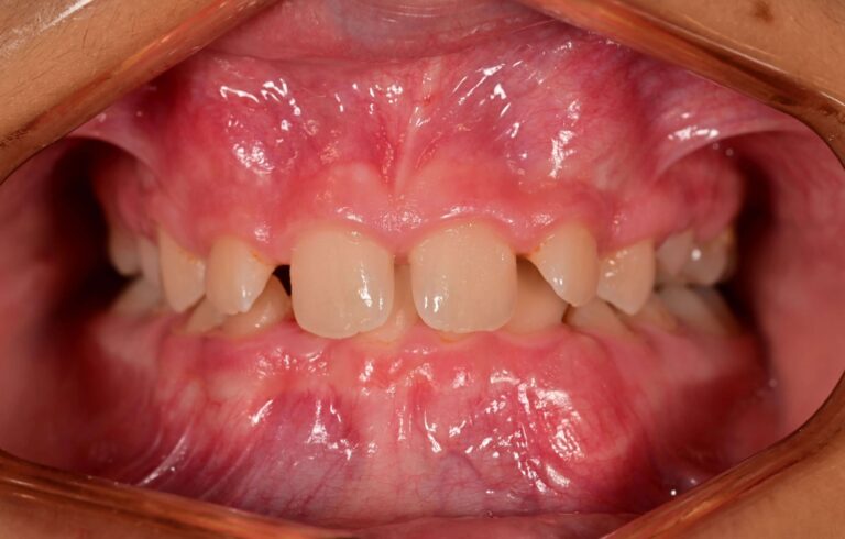 Разтояние между зъбите