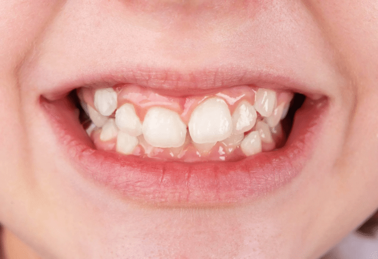 Скупчени зъби