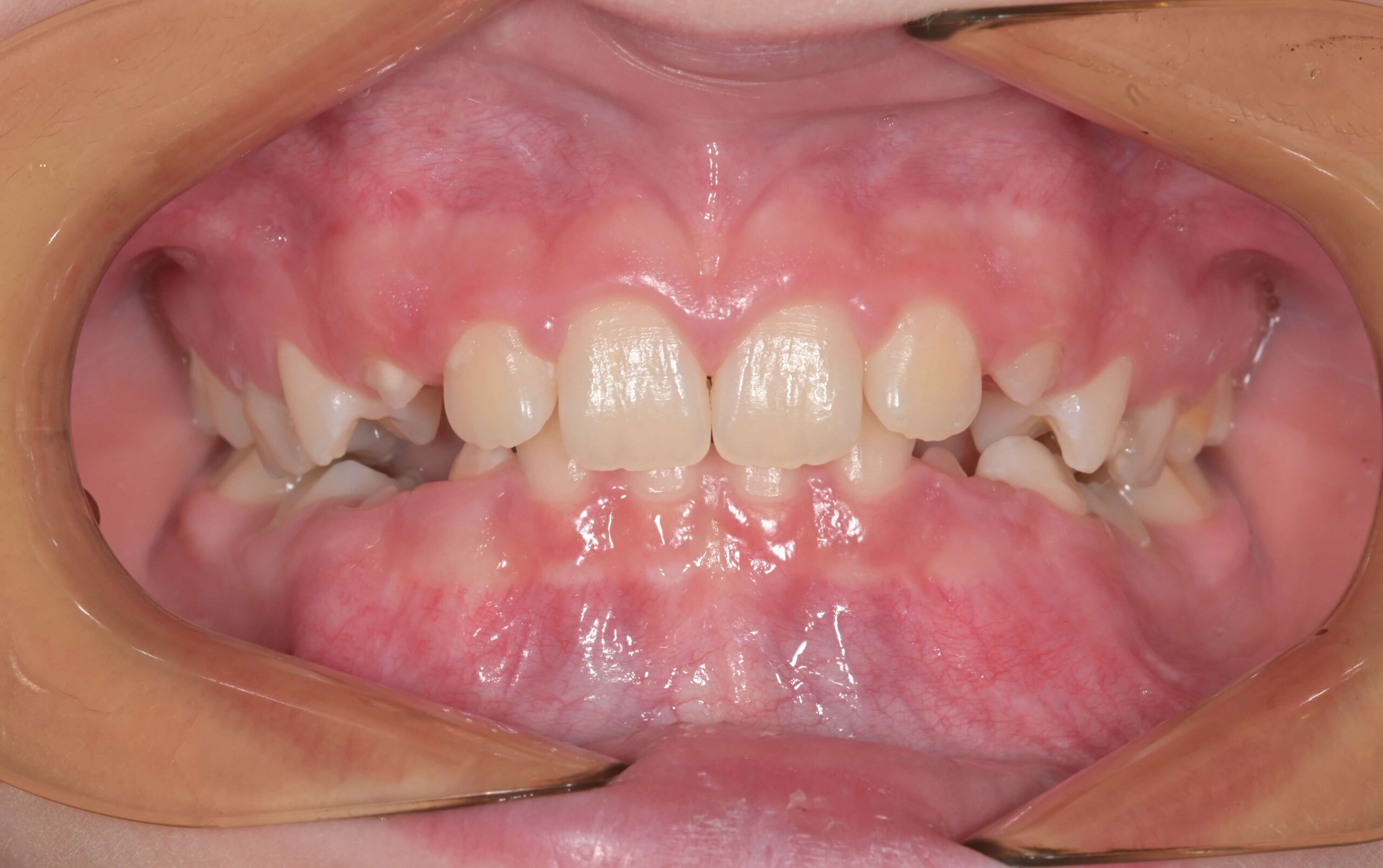 Дълбока захапка - причини, последици и видове лечение