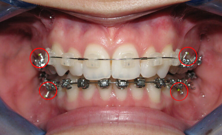 Лечение на дълбока захапка с брекети