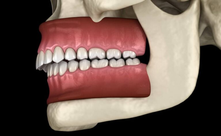 Защо трябва да се коригира дълбоката захапка