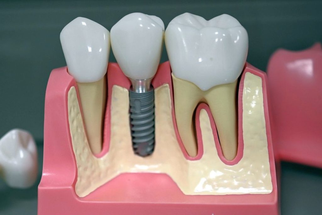 Импланти - най-добрия избор при загуба на зъб.