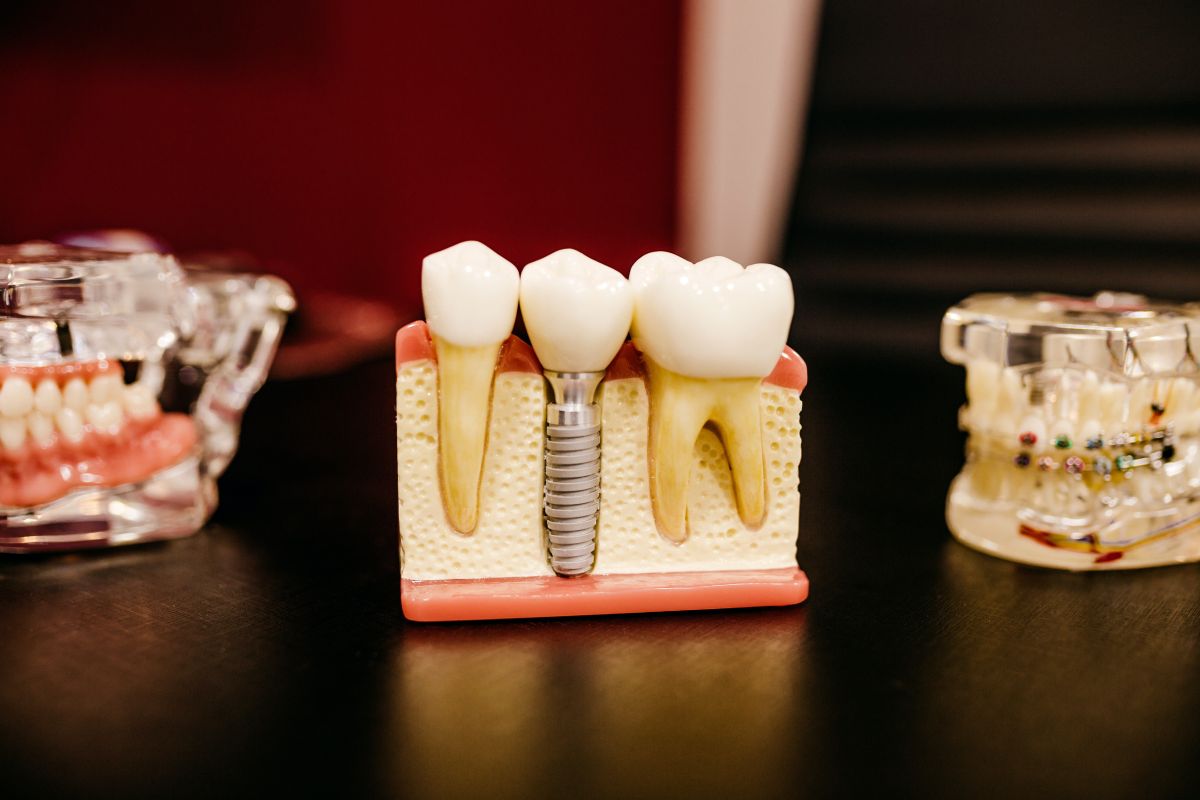 Зъбни импланти - най-важните неща, които трябва да знаете за тях.